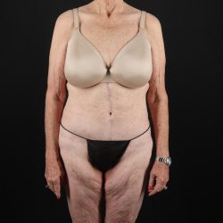 Fleur De Lis Tummy Tuck Before & After Patient #9505