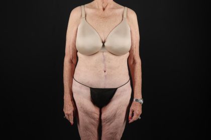 Fleur De Lis Tummy Tuck Before & After Patient #9505