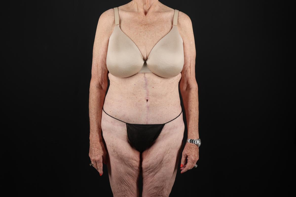 Fleur De Lis Tummy Tuck Before & After Patient #9505