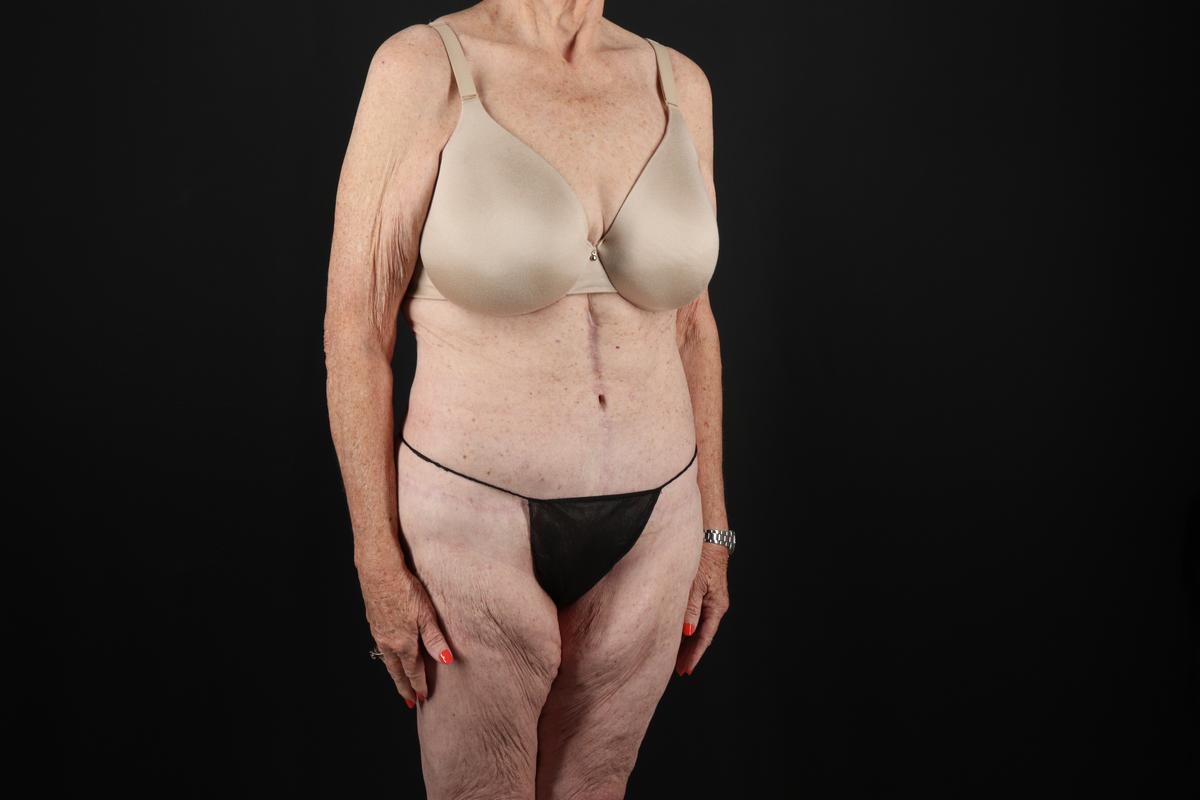 Fleur De Lis Tummy Tuck Before & After Patient #9505
