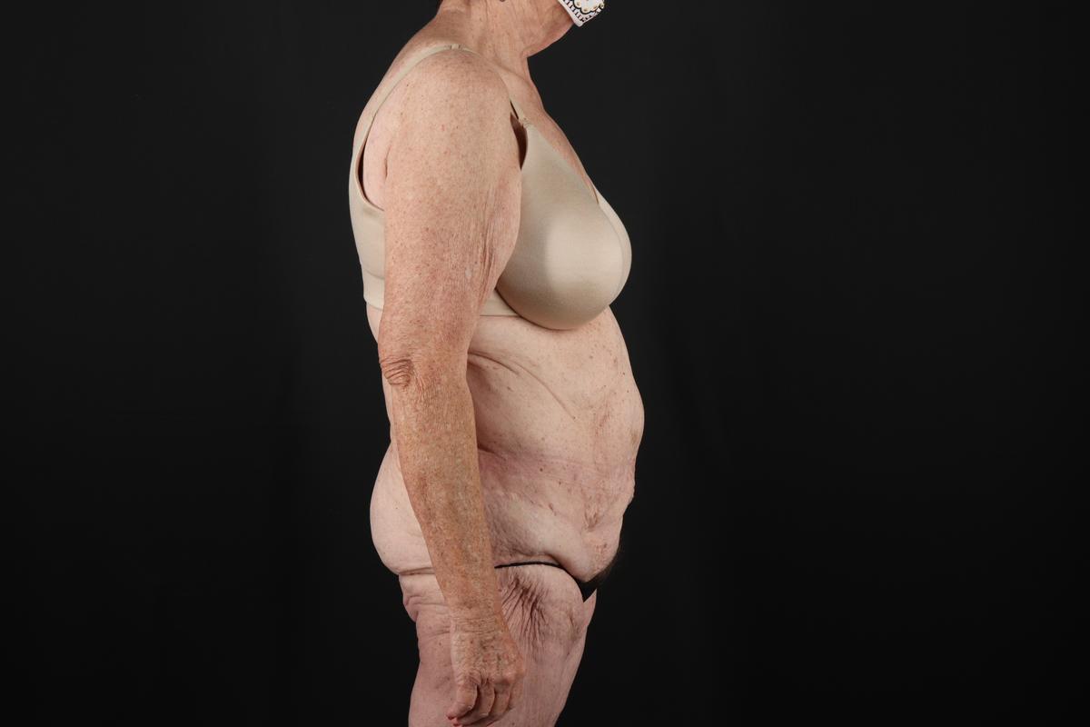 Fleur De Lis Tummy Tuck Before & After Patient #9505