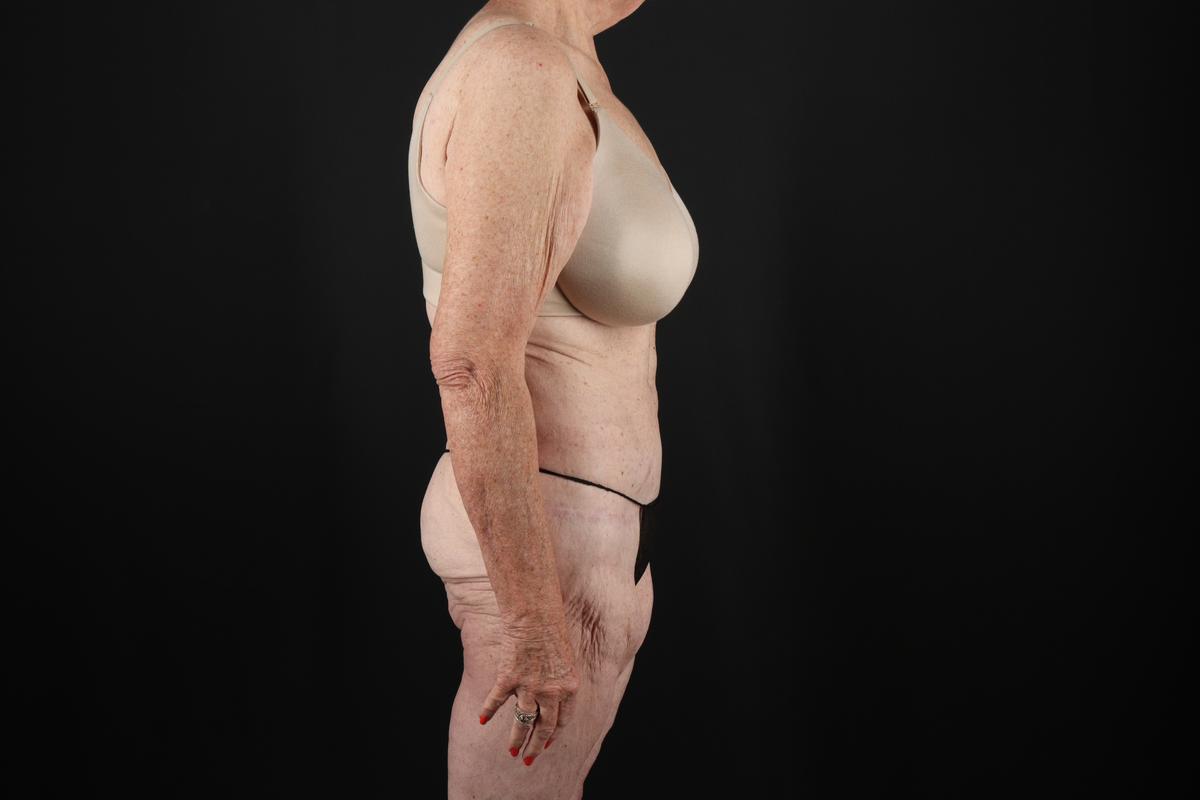 Fleur De Lis Tummy Tuck Before & After Patient #9505