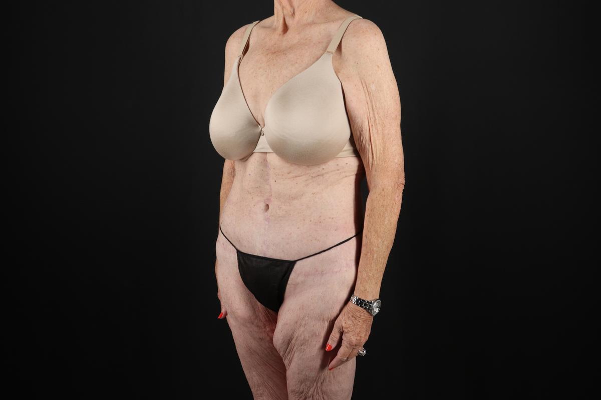 Fleur De Lis Tummy Tuck Before & After Patient #9505