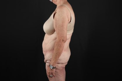 Fleur De Lis Tummy Tuck Before & After Patient #9505
