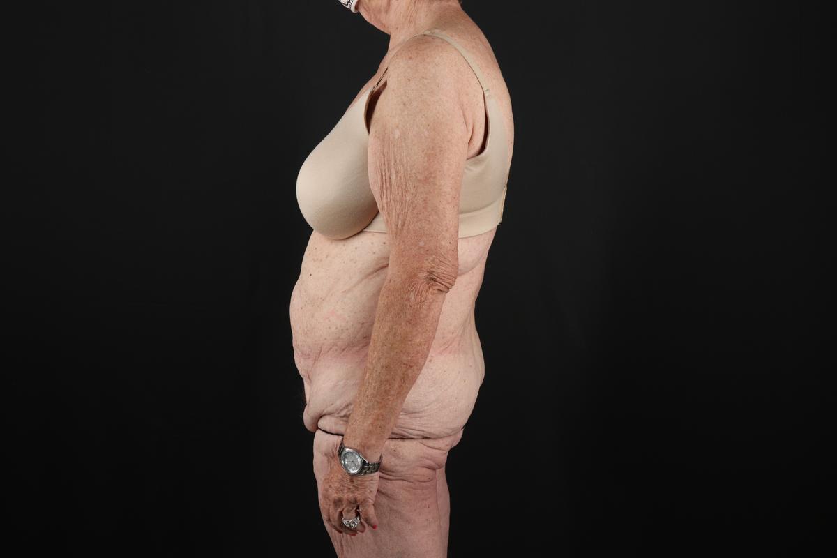 Fleur De Lis Tummy Tuck Before & After Patient #9505
