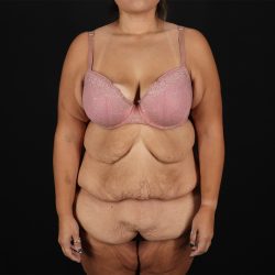 Fleur De Lis Tummy Tuck Before & After Patient #9508