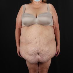 Fleur De Lis Circumferential Body Lift Before & After Patient #9286