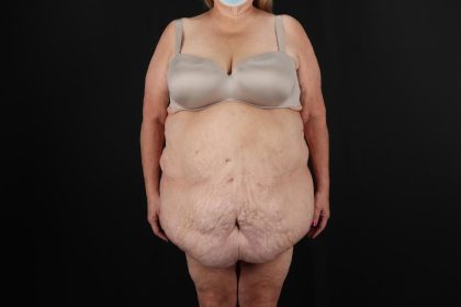Fleur De Lis Circumferential Body Lift Before & After Patient #9286