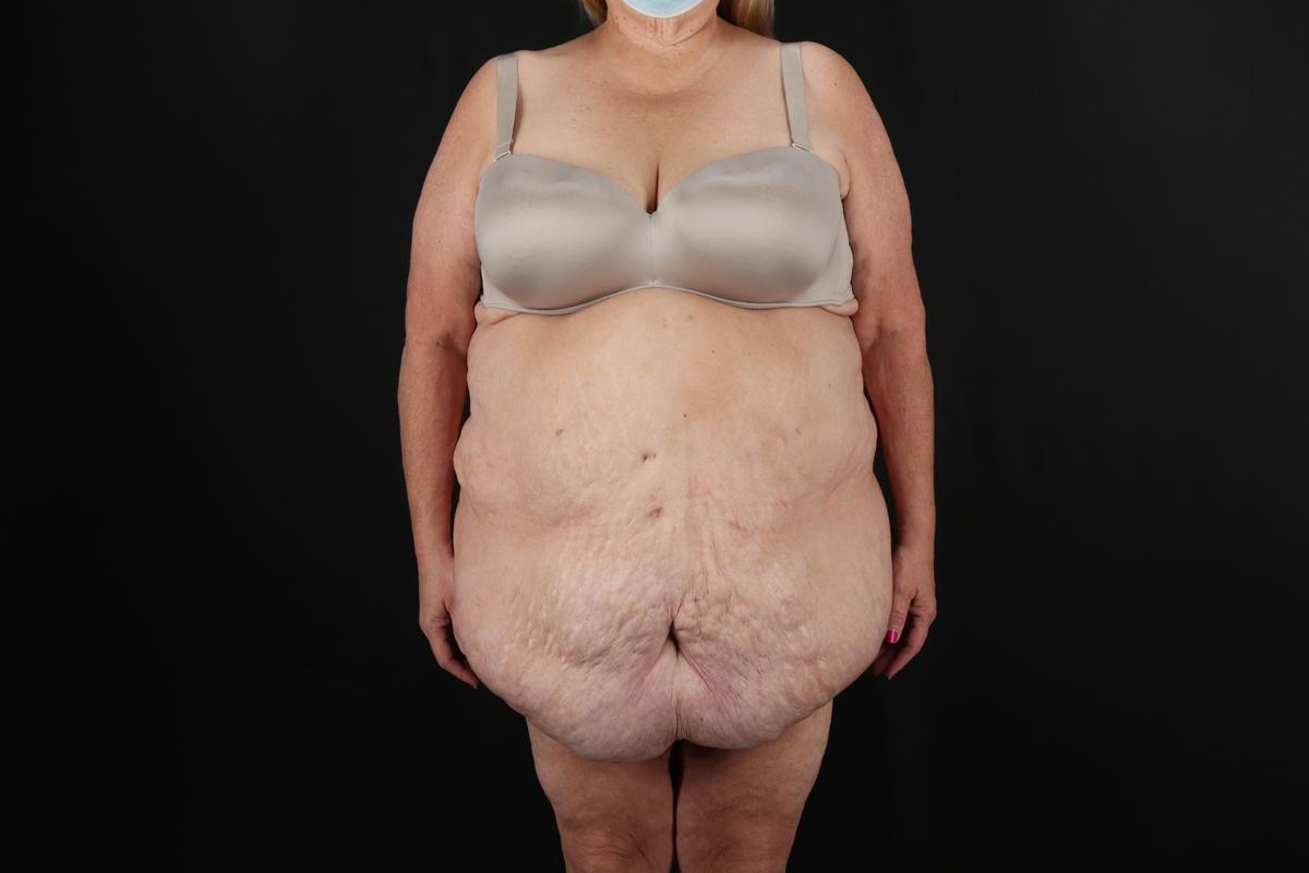 Fleur De Lis Circumferential Body Lift Before & After Patient #9286