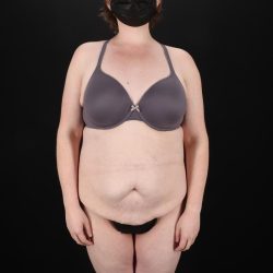 Fleur De Lis Tummy Tuck Before & After Patient #9506