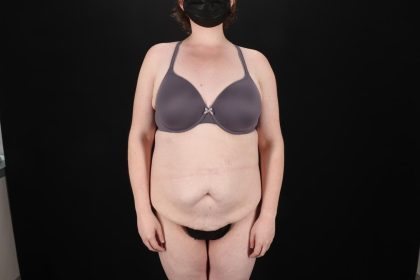 Fleur De Lis Tummy Tuck Before & After Patient #9506