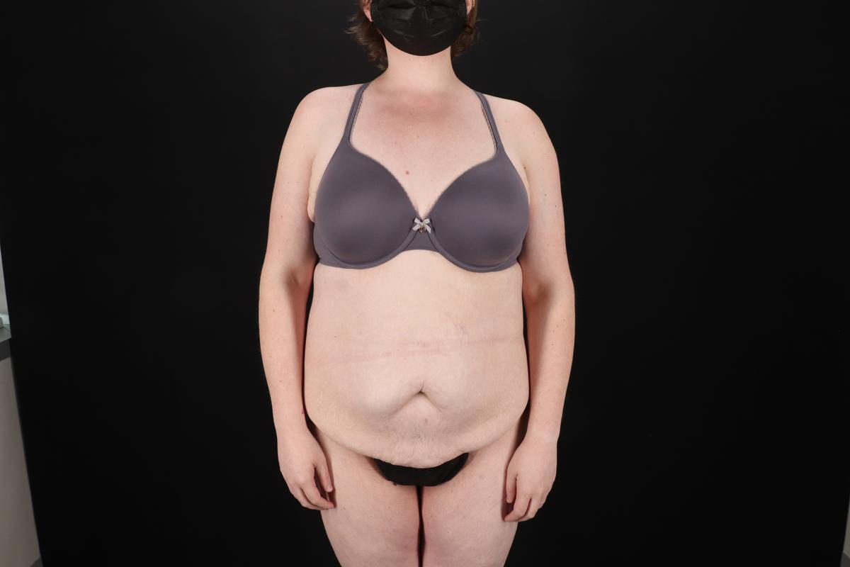 Fleur De Lis Tummy Tuck Before & After Patient #9506