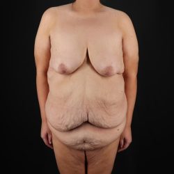 Fleur De Lis Circumferential Body Lift Before & After Patient #9287