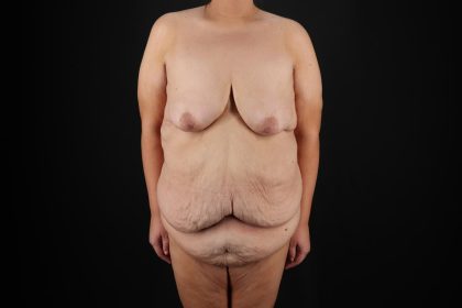 Fleur De Lis Circumferential Body Lift Before & After Patient #9287