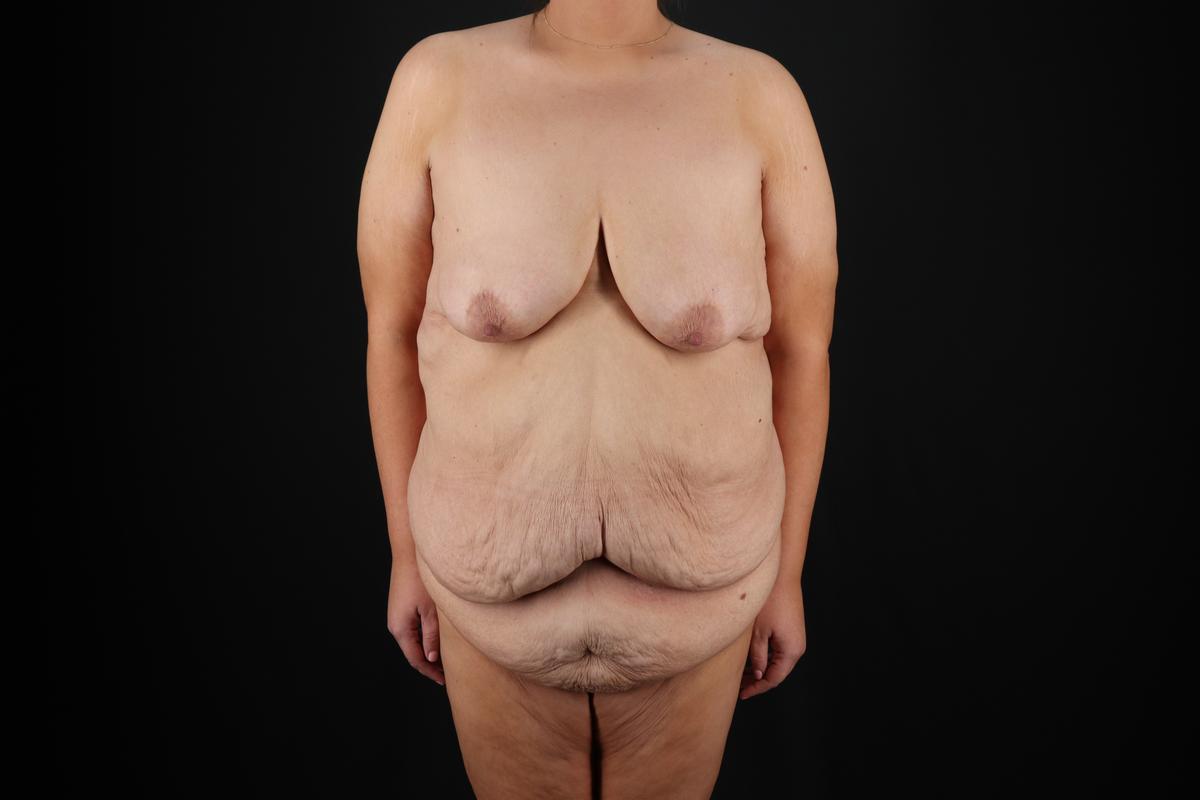 Fleur De Lis Circumferential Body Lift Before & After Patient #9287