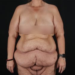Fleur De Lis Tummy Tuck Before & After Patient #9509