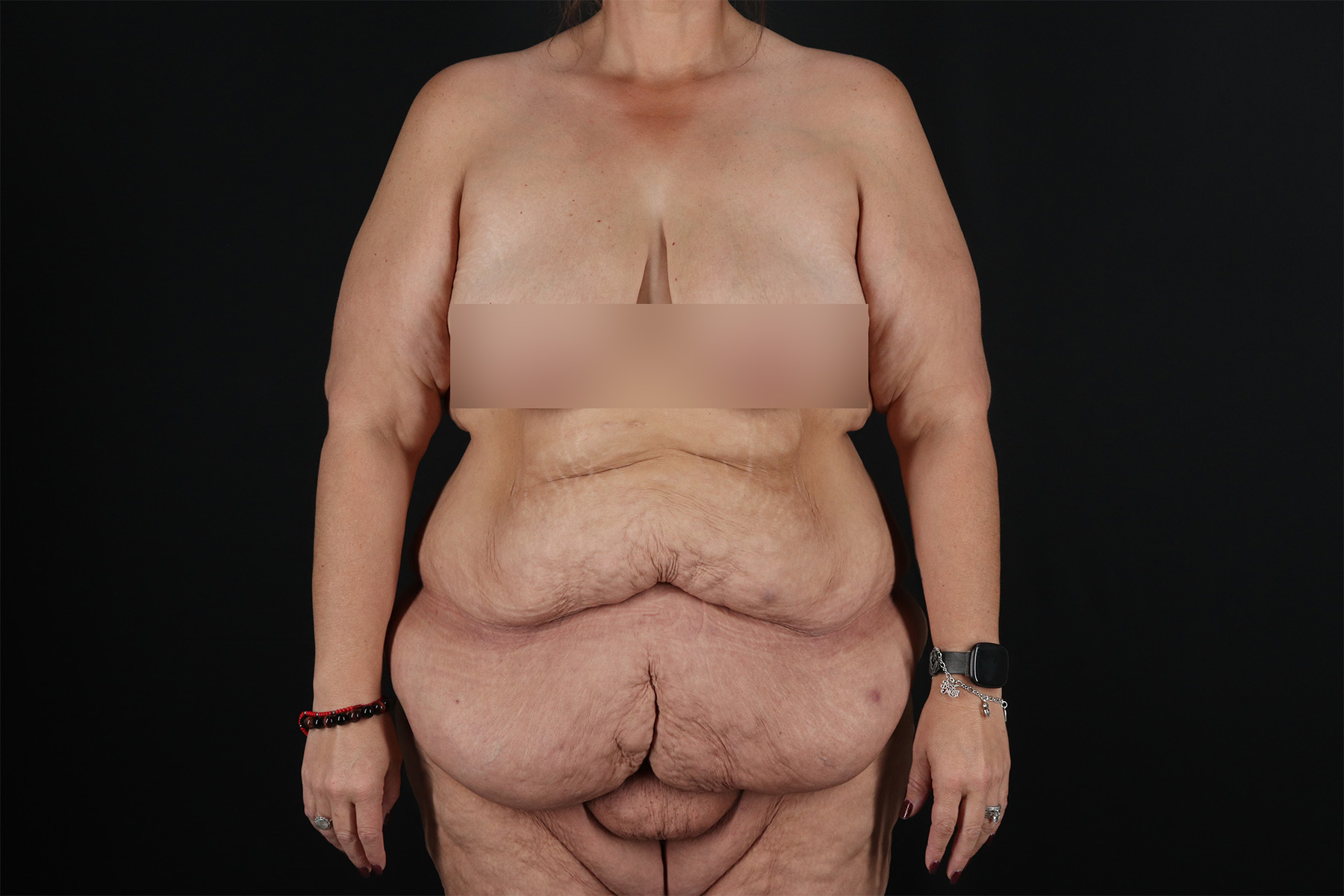 Fleur De Lis Tummy Tuck Before & After Patient #9509