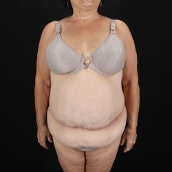 Fleur De Lis Tummy Tuck Before & After Patient #9507
