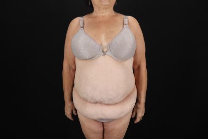 Fleur De Lis Tummy Tuck Before & After Patient #9507