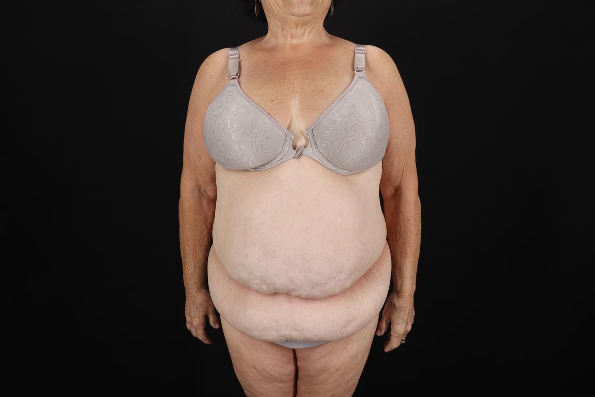 Fleur De Lis Tummy Tuck Before & After Patient #9507