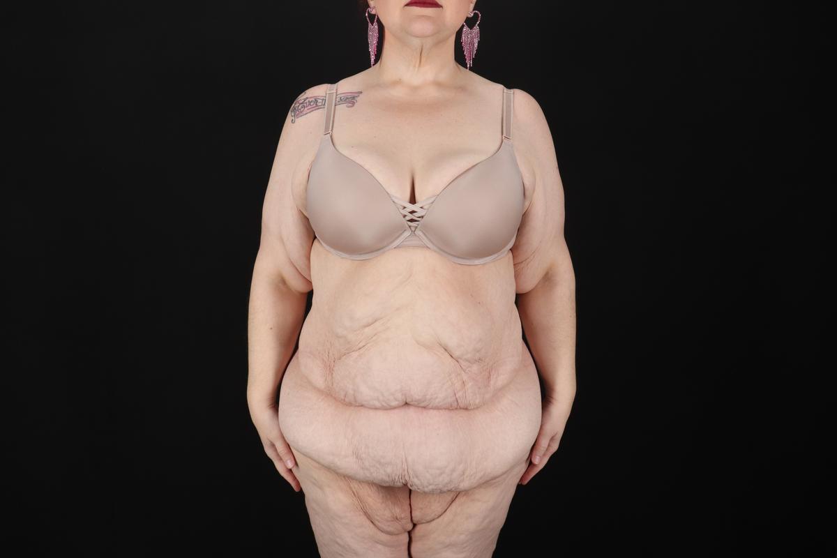 Fleur De Lis Circumferential Body Lift Before & After Patient #9283