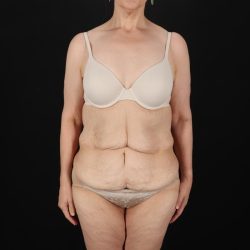 Fleur De Lis Circumferential Body Lift Before & After Patient #9328