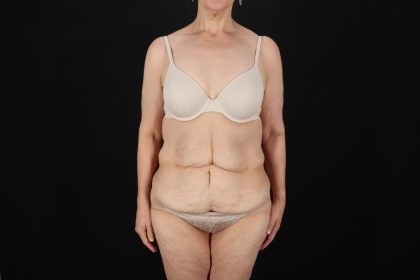 Fleur De Lis Circumferential Body Lift Before & After Patient #9328