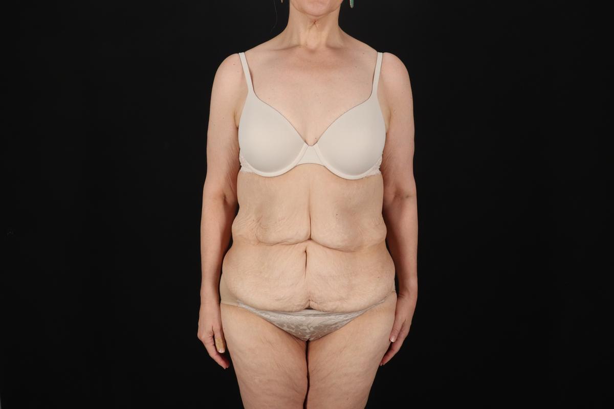 Fleur De Lis Circumferential Body Lift Before & After Patient #9328