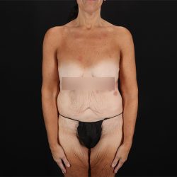 Fleur De Lis Circumferential Body Lift Before & After Patient #9279