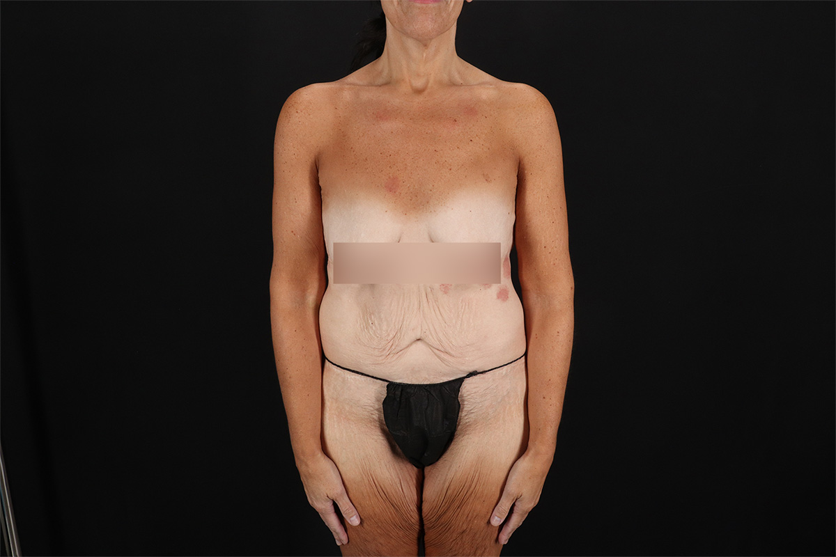 Fleur De Lis Circumferential Body Lift Before & After Patient #9279