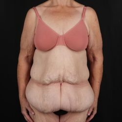 Fleur De Lis Circumferential Body Lift Before & After Patient #9285