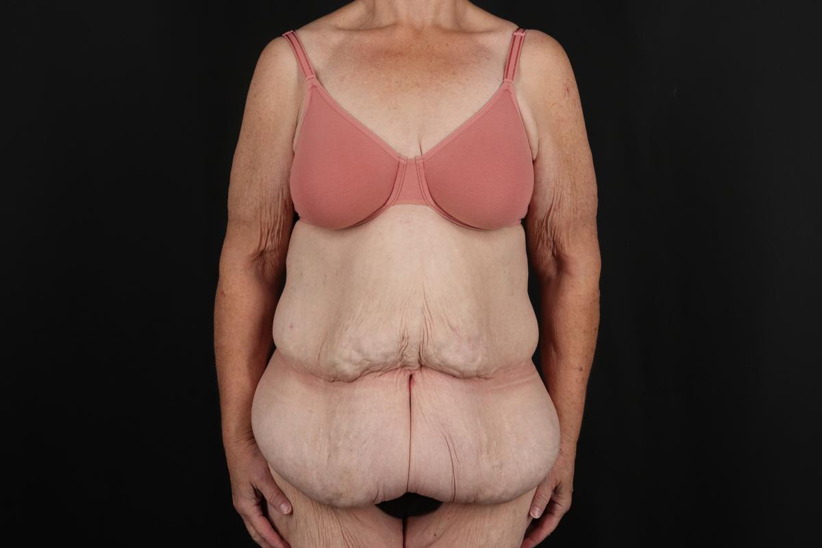 Fleur De Lis Circumferential Body Lift Before & After Patient #9285