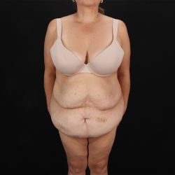 Fleur De Lis Tummy Tuck Before & After Patient #9510