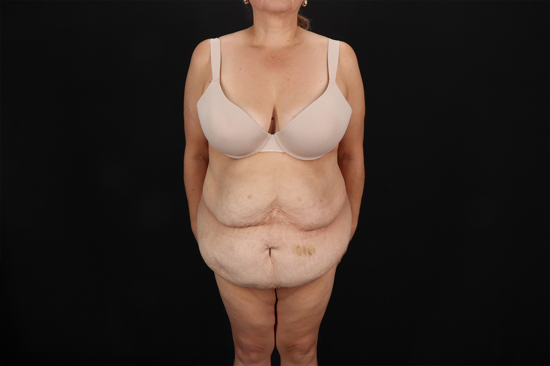 Fleur De Lis Tummy Tuck Before & After Patient #9510