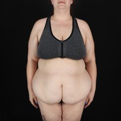Fleur De Lis Circumferential Body Lift Before & After Patient #9284