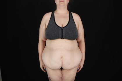 Fleur De Lis Circumferential Body Lift Before & After Patient #9284