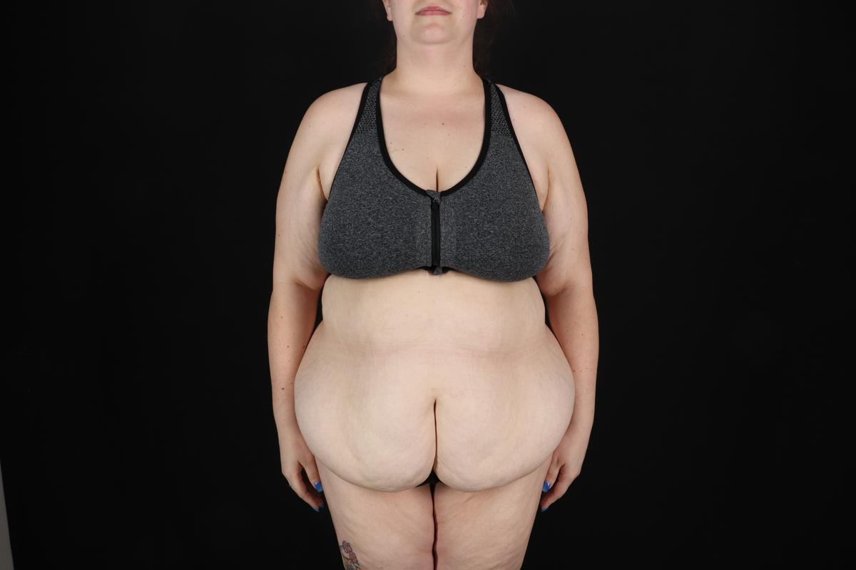 Fleur De Lis Circumferential Body Lift Before & After Patient #9284