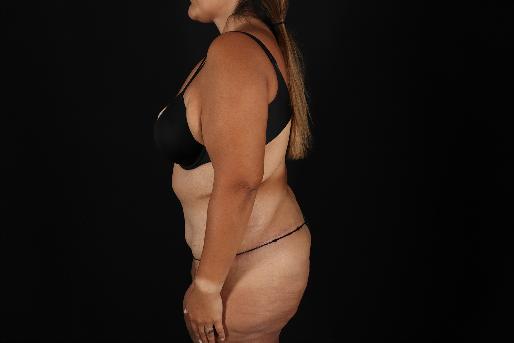 Fleur De Lis Tummy Tuck Before & After Patient #9508