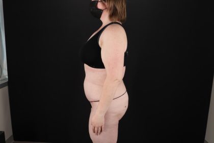 Fleur De Lis Tummy Tuck Before & After Patient #9506