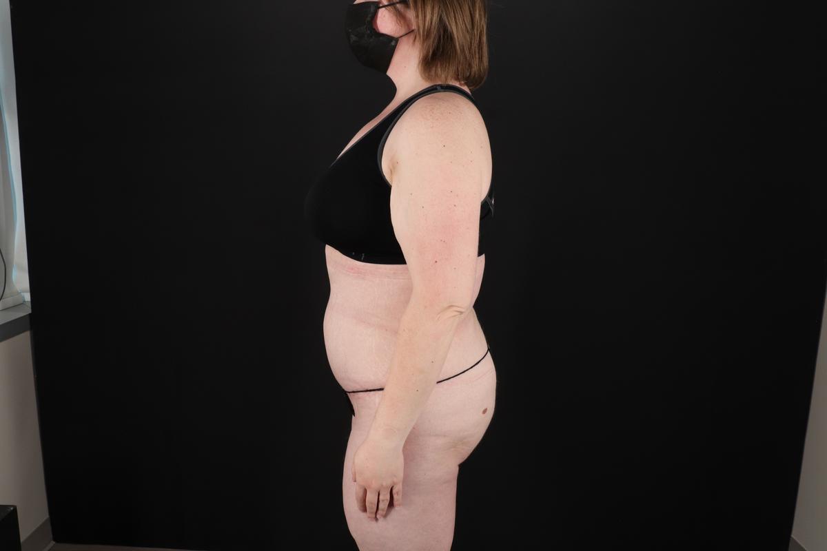 Fleur De Lis Tummy Tuck Before & After Patient #9506