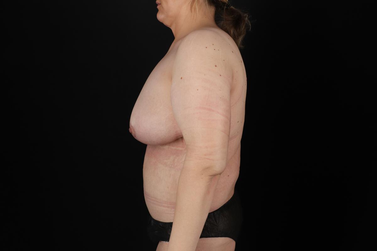 Fleur De Lis Circumferential Body Lift Before & After Patient #9287