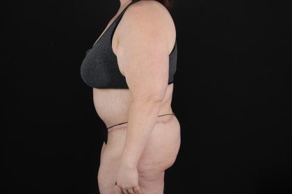 Fleur De Lis Circumferential Body Lift Before & After Patient #9284