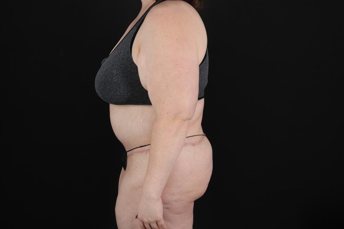 Fleur De Lis Circumferential Body Lift Before & After Patient #9284