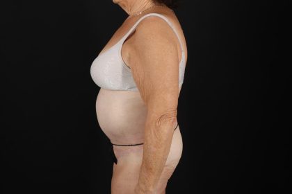 Fleur De Lis Tummy Tuck Before & After Patient #9507