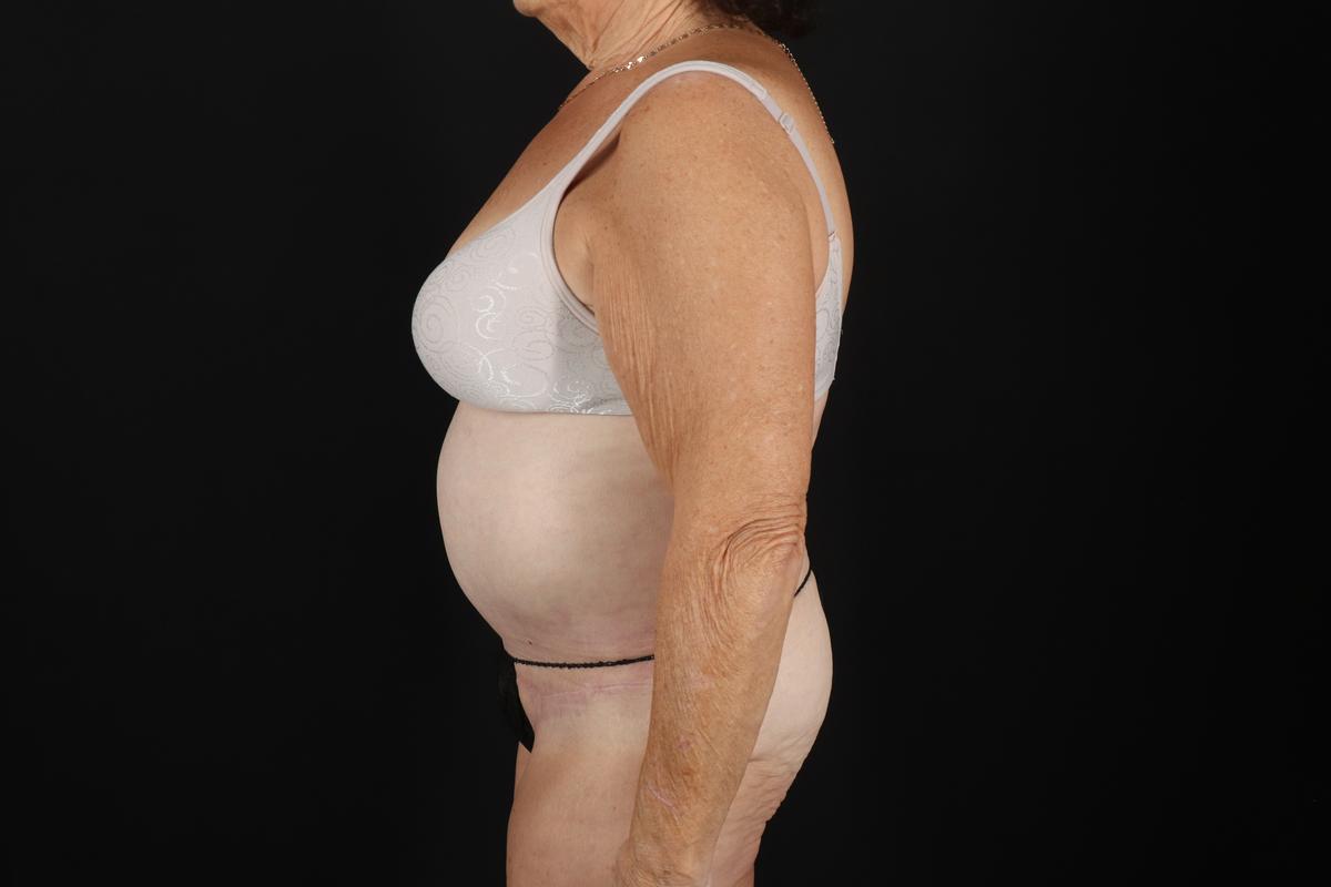 Fleur De Lis Tummy Tuck Before & After Patient #9507