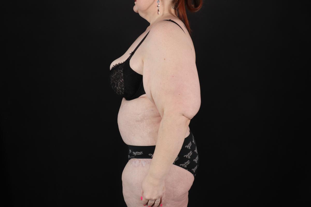 Fleur De Lis Circumferential Body Lift Before & After Patient #9283