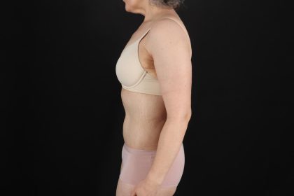 Fleur De Lis Circumferential Body Lift Before & After Patient #9328