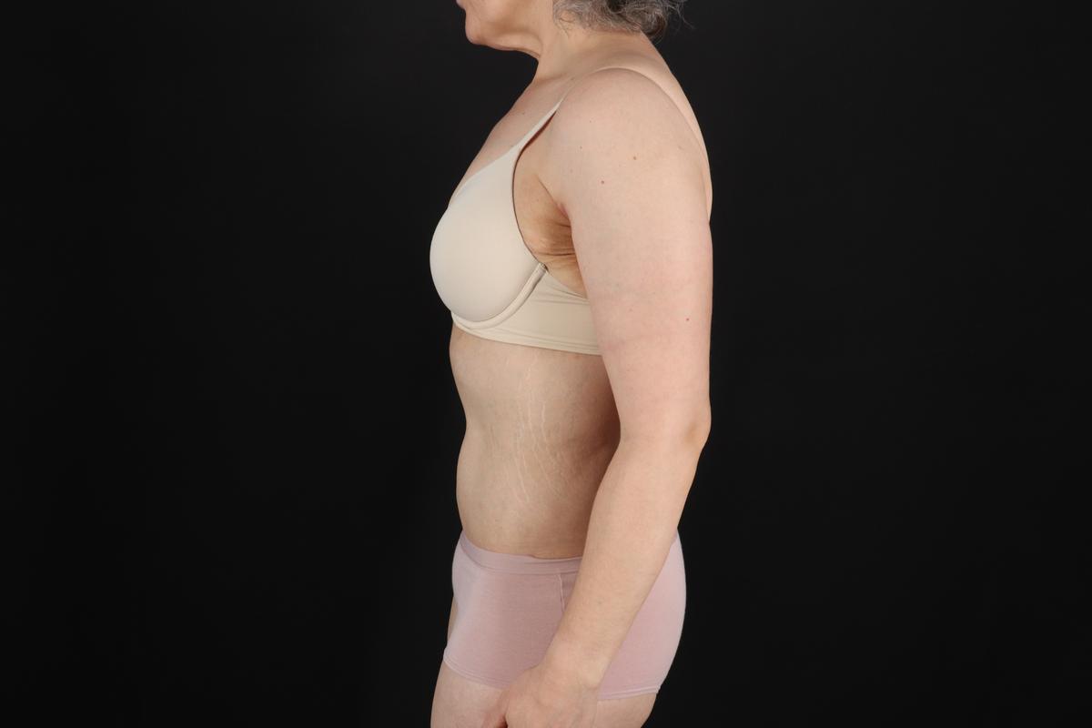 Fleur De Lis Circumferential Body Lift Before & After Patient #9328