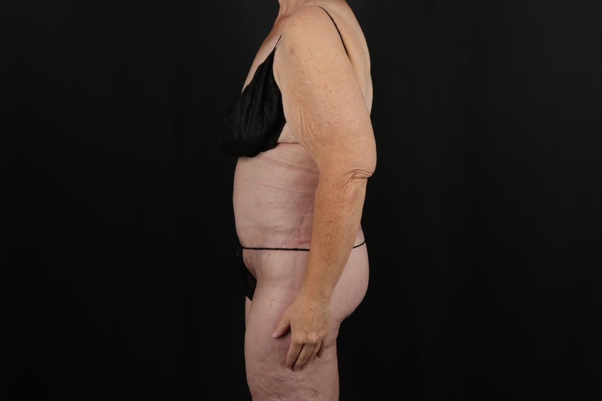 Fleur De Lis Circumferential Body Lift Before & After Patient #9285