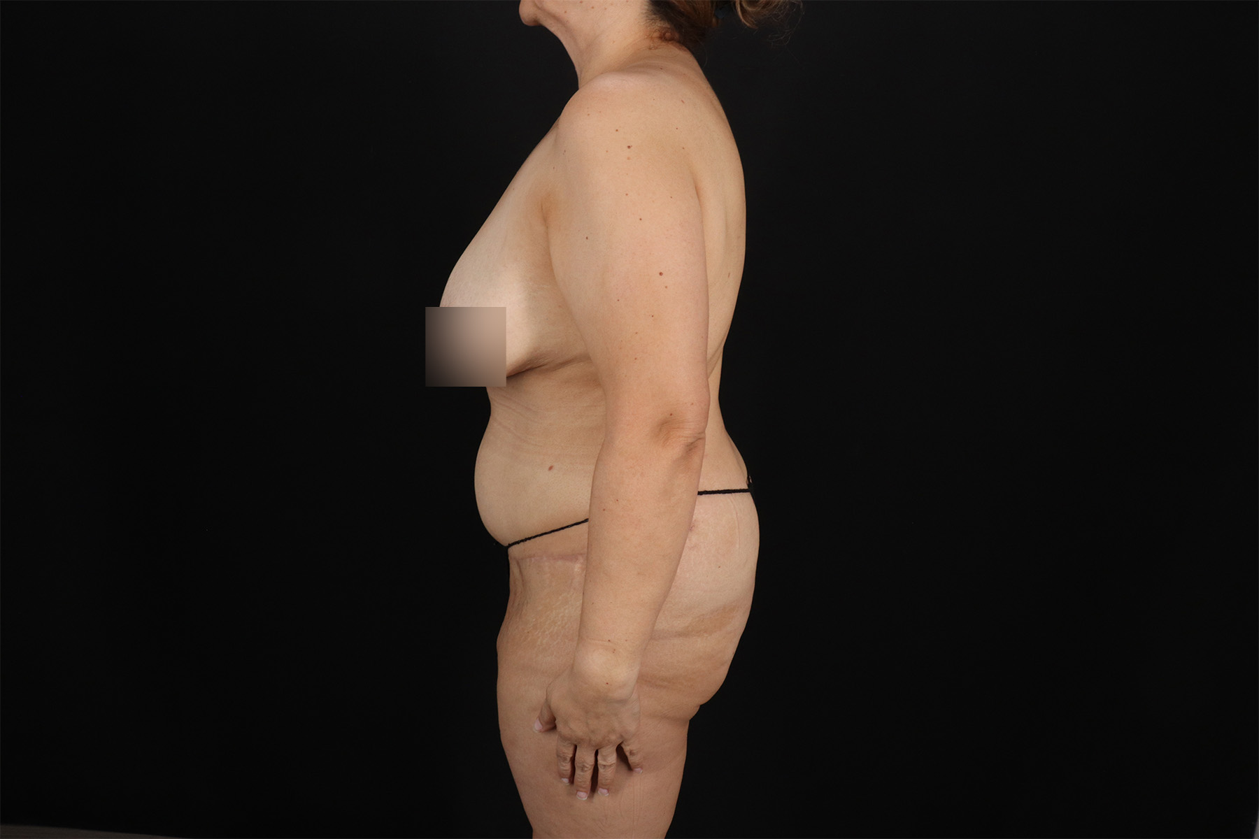 Fleur De Lis Tummy Tuck Before & After Patient #9510